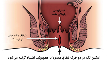 جراحی شقاق مزمن