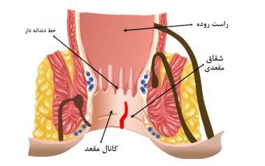 عمل شقاق با لیزر