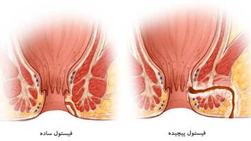 درمان فیستول بالیزر