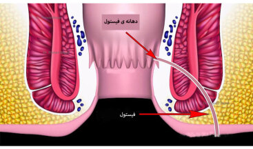 درمان فیستول بالیزر