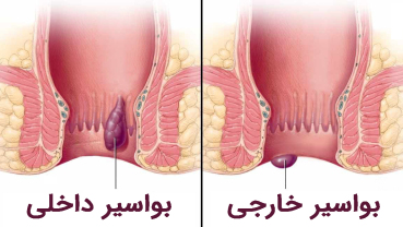 درمان هموروئید داخلی