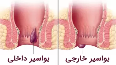 درمان هموروئید داخلی