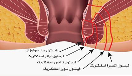 انواع فیستول